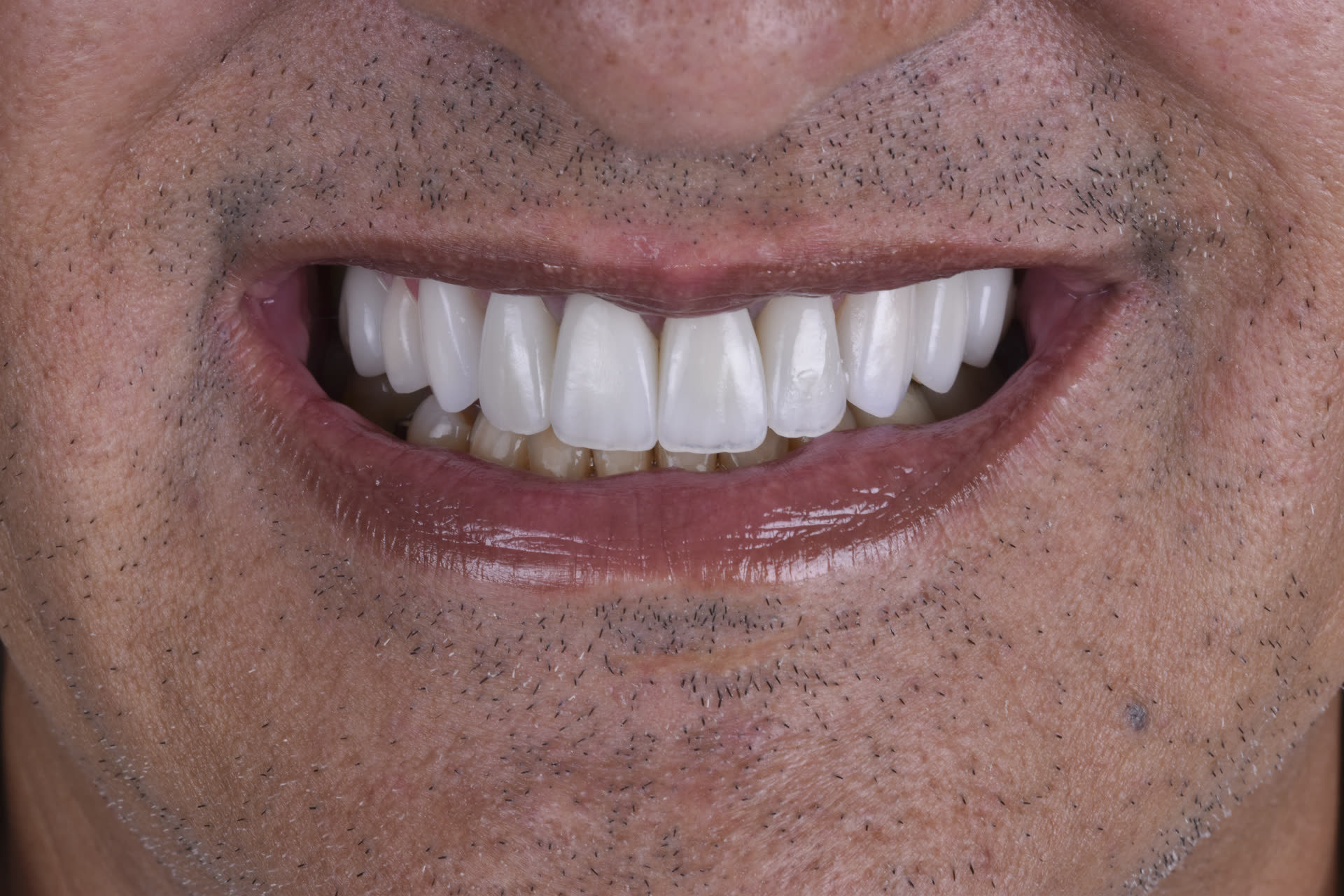 Rehabilitación oral
