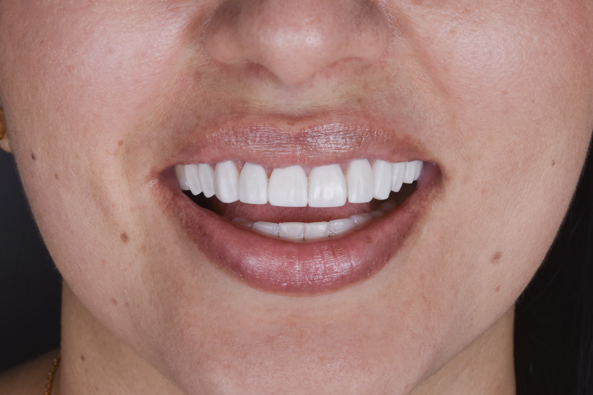 Blanqueamiento dental